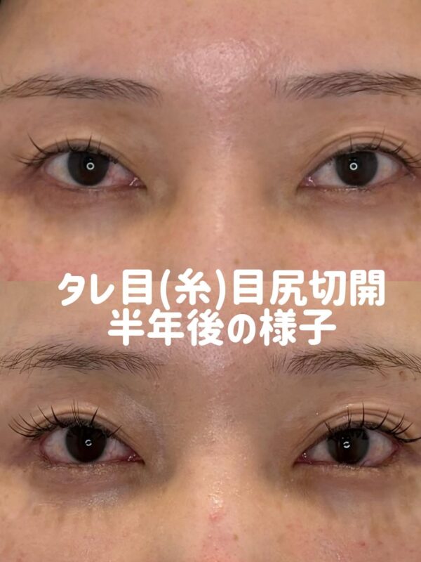 362 タレ目形成 × 目尻切開