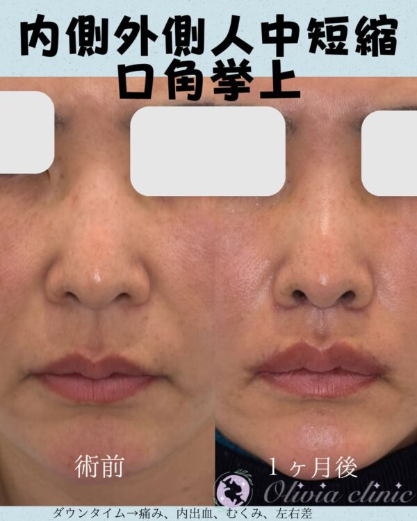 363 内側外側人中短縮 × 口角挙上