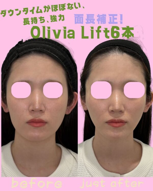 364 Olivia lift