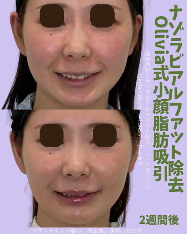 365 Olivia式小顔脂肪吸引 × ナゾラビアルファット除去 × フェイスライン × Olivia lift